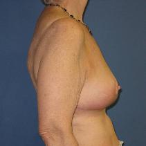 Breast Lift After Photo by Neal Goldberg, MD; Scarsdale, NY - Case 10173
