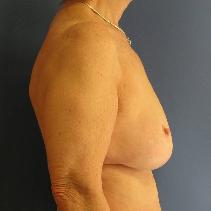 Breast Lift Before Photo by Neal Goldberg, MD; Scarsdale, NY - Case 10173