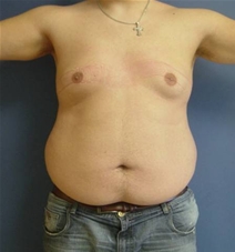 Liposuction Before Photo by Neal Goldberg, MD; Scarsdale, NY - Case 10175