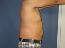 Liposuction After Photo by Neal Goldberg, MD; Scarsdale, NY - Case 10175