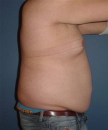 Liposuction Before Photo by Neal Goldberg, MD; Scarsdale, NY - Case 10175