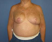 Breast Reconstruction After Photo by Neal Goldberg, MD; Scarsdale, NY - Case 10209