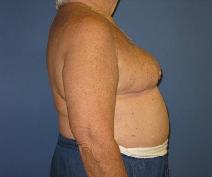 Breast Reconstruction Before Photo by Neal Goldberg, MD; Scarsdale, NY - Case 10209