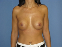 Breast Augmentation After Photo by Neal Goldberg, MD; Scarsdale, NY - Case 10388