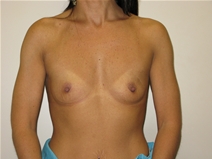 Breast Augmentation Before Photo by Neal Goldberg, MD; Scarsdale, NY - Case 10388