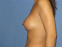 Breast Augmentation After Photo by Neal Goldberg, MD; Scarsdale, NY - Case 10388