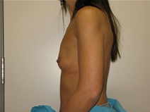Breast Augmentation Before Photo by Neal Goldberg, MD; Scarsdale, NY - Case 10388