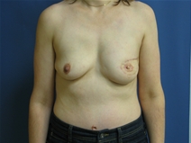 Breast Reconstruction After Photo by Neal Goldberg, MD; Scarsdale, NY - Case 10399