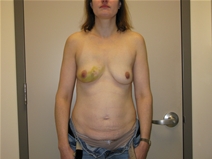 Breast Reconstruction Before Photo by Neal Goldberg, MD; Scarsdale, NY - Case 10399