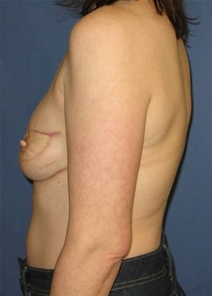Breast Reconstruction After Photo by Neal Goldberg, MD; Scarsdale, NY - Case 10399
