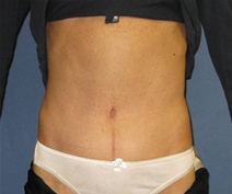 Tummy Tuck After Photo by Neal Goldberg, MD; Scarsdale, NY - Case 10400