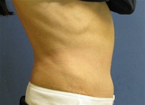 Tummy Tuck After Photo by Neal Goldberg, MD; Scarsdale, NY - Case 10400