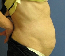 Tummy Tuck Before Photo by Neal Goldberg, MD; Scarsdale, NY - Case 10400