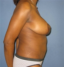 Breast Lift After Photo by Neal Goldberg, MD; Scarsdale, NY - Case 10401