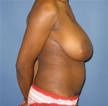 Breast Lift Before Photo by Neal Goldberg, MD; Scarsdale, NY - Case 10401