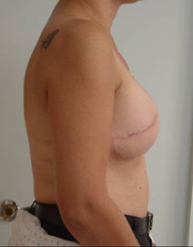 Breast Reconstruction After Photo by Neal Goldberg, MD; Scarsdale, NY - Case 10489