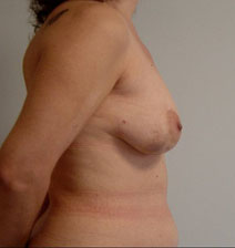 Breast Reconstruction Before Photo by Neal Goldberg, MD; Scarsdale, NY - Case 10489