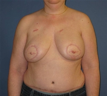 Breast Reconstruction After Photo by Neal Goldberg, MD; Scarsdale, NY - Case 10490