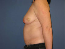Breast Reconstruction Before Photo by Neal Goldberg, MD; Scarsdale, NY - Case 10490