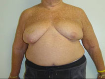 Breast Reconstruction Before Photo by Neal Goldberg, MD; Scarsdale, NY - Case 10491