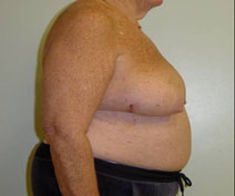 Breast Reconstruction Before Photo by Neal Goldberg, MD; Scarsdale, NY - Case 10491