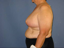 Breast Reduction After Photo by Neal Goldberg, MD; Scarsdale, NY - Case 10493