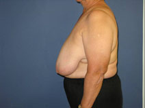Breast Reduction Before Photo by Neal Goldberg, MD; Scarsdale, NY - Case 10493