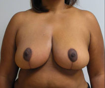 Breast Reduction After Photo by Neal Goldberg, MD; Scarsdale, NY - Case 10494