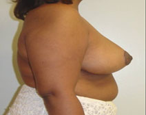 Breast Reduction After Photo by Neal Goldberg, MD; Scarsdale, NY - Case 10494