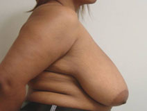 Breast Reduction Before Photo by Neal Goldberg, MD; Scarsdale, NY - Case 10494