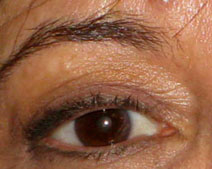 Eyelid Surgery Before Photo by Neal Goldberg, MD; Scarsdale, NY - Case 10495