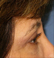 Eyelid Surgery After Photo by Neal Goldberg, MD; Scarsdale, NY - Case 10495
