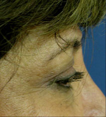 Eyelid Surgery Before Photo by Neal Goldberg, MD; Scarsdale, NY - Case 10495