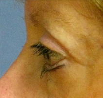Eyelid Surgery After Photo by Neal Goldberg, MD; Scarsdale, NY - Case 10496
