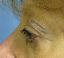 Eyelid Surgery Before Photo by Neal Goldberg, MD; Scarsdale, NY - Case 10496