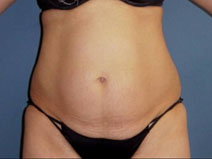 Tummy Tuck Before Photo by Neal Goldberg, MD; Scarsdale, NY - Case 10497