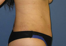 Tummy Tuck After Photo by Neal Goldberg, MD; Scarsdale, NY - Case 10497