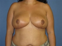 Breast Reduction After Photo by Neal Goldberg, MD; Scarsdale, NY - Case 10500