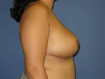 Breast Reduction After Photo by Neal Goldberg, MD; Scarsdale, NY - Case 10500