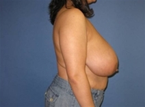 Breast Reduction Before Photo by Neal Goldberg, MD; Scarsdale, NY - Case 10500