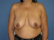 Breast Lift Before Photo by Neal Goldberg, MD; Scarsdale, NY - Case 10501
