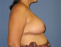 Breast Lift After Photo by Neal Goldberg, MD; Scarsdale, NY - Case 10501