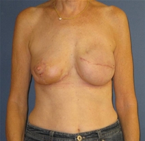 Breast Reconstruction After Photo by Neal Goldberg, MD; Scarsdale, NY - Case 20723