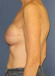 Breast Reconstruction After Photo by Neal Goldberg, MD; Scarsdale, NY - Case 20723
