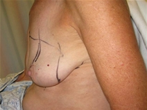 Breast Reconstruction Before Photo by Neal Goldberg, MD; Scarsdale, NY - Case 20723