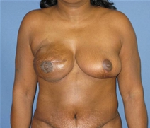 Breast Reconstruction After Photo by Neal Goldberg, MD; Scarsdale, NY - Case 20724