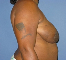 Breast Reconstruction Before Photo by Neal Goldberg, MD; Scarsdale, NY - Case 20724