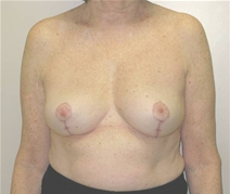 Breast Lift After Photo by Neal Goldberg, MD; Scarsdale, NY - Case 20725