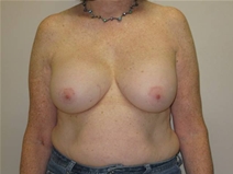Breast Lift Before Photo by Neal Goldberg, MD; Scarsdale, NY - Case 20725
