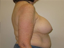 Breast Lift Before Photo by Neal Goldberg, MD; Scarsdale, NY - Case 20725